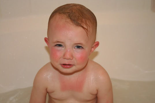 UV_prevention